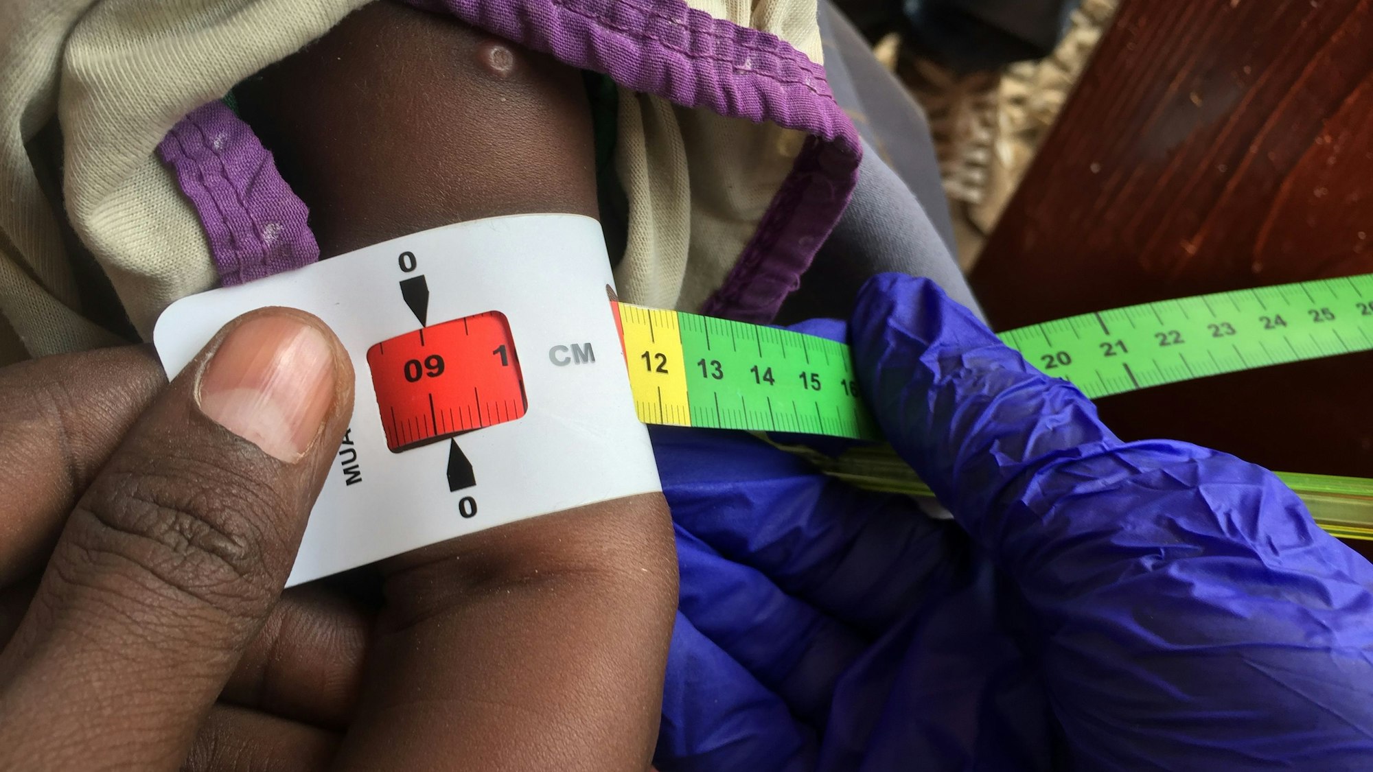 Ein Arzt misst den Armumfang eines unterernährten Babys. Die rote Markierung bedeutet: Das Kind ist schwer unterernährt und braucht dringend Spezialnahrung. (Archivbild)
