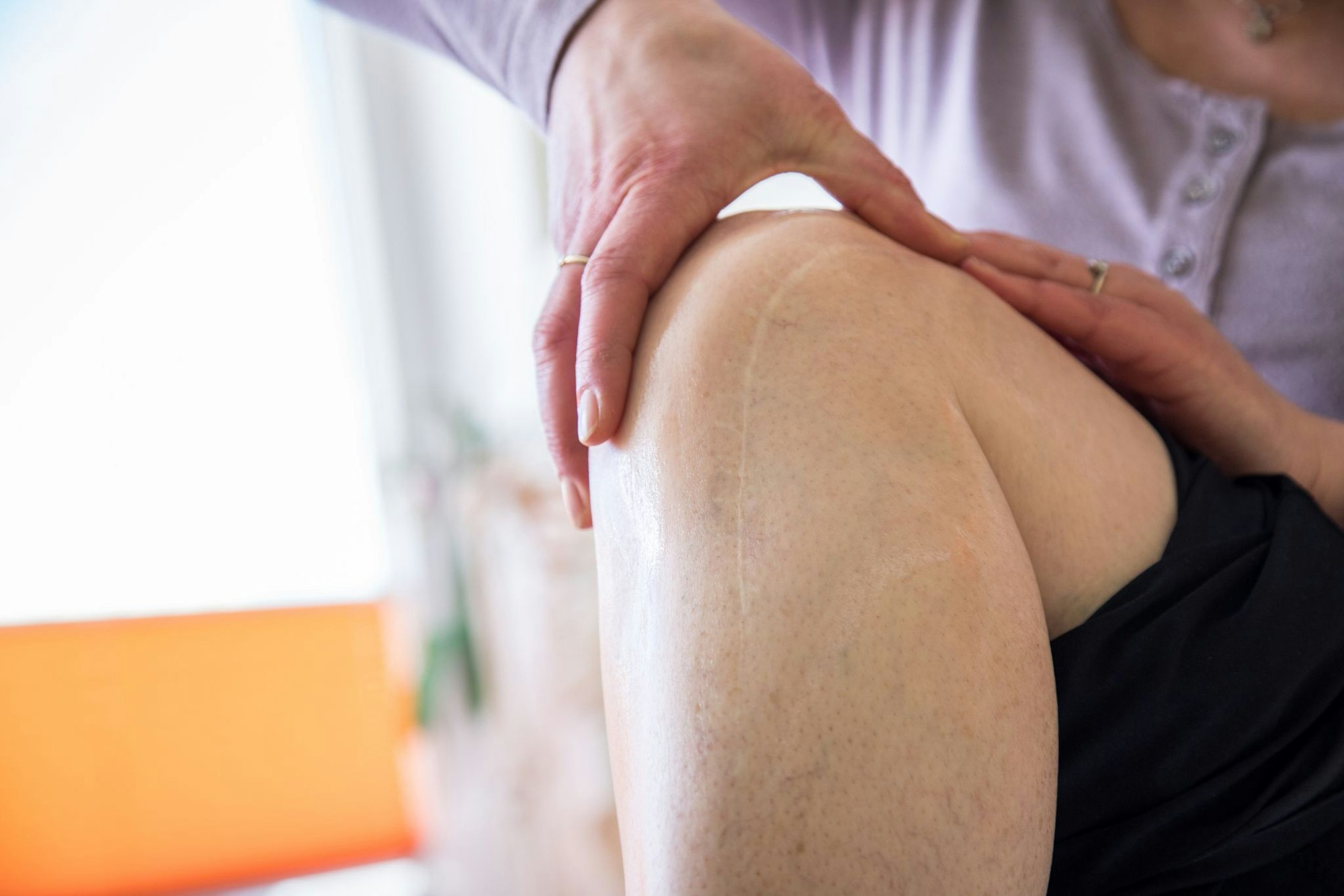 Es geht nicht nur ums Aussehen: Narben, die unschön verheilen, sind manchmal auch ein medizinisches Problem.