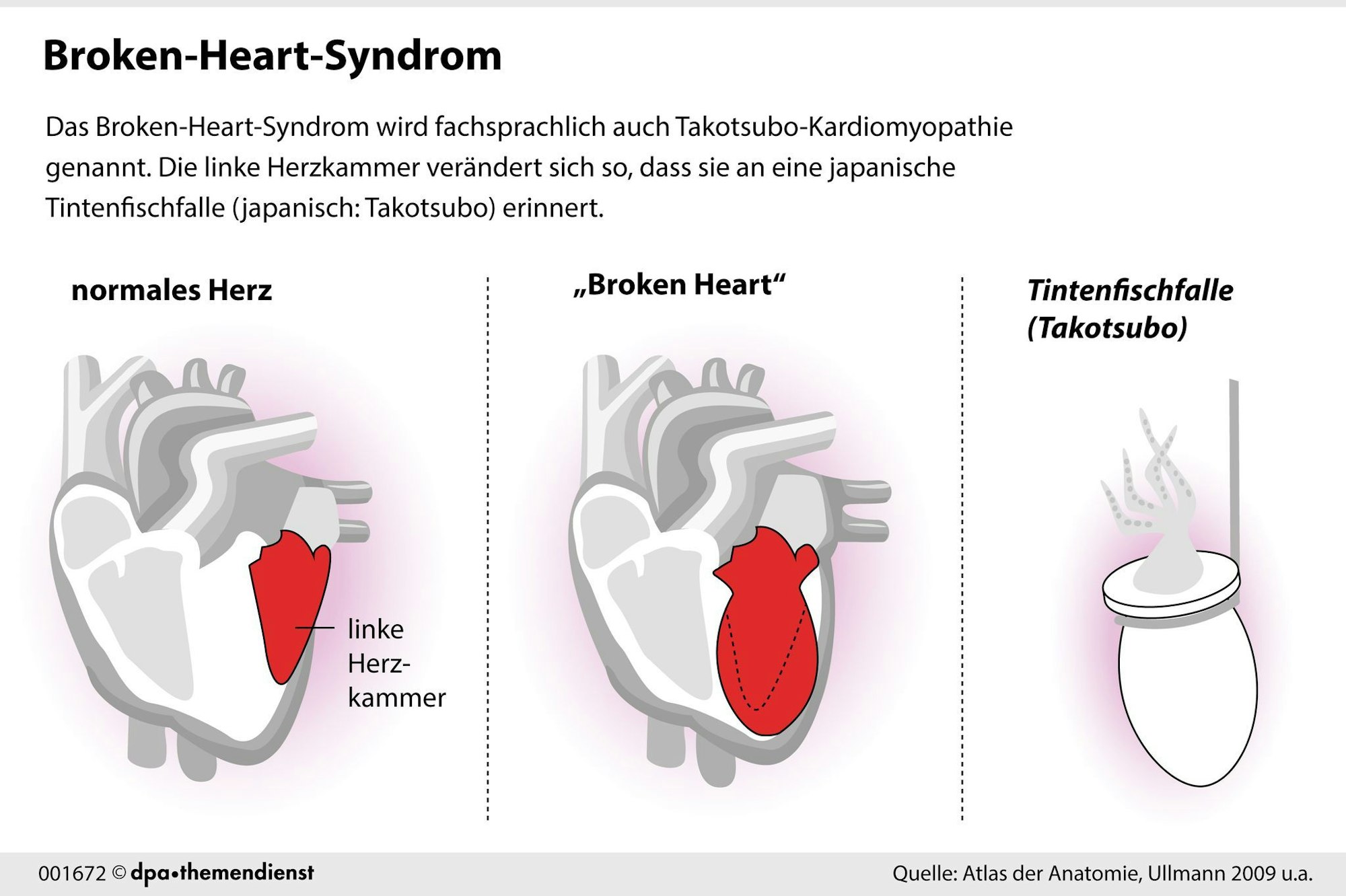 Das Broken-Heart-Syndrom erinnert an einen Herzinfarkt. Tatsächlich verändert sich dabei aber vor allem die linke Herzkammer.