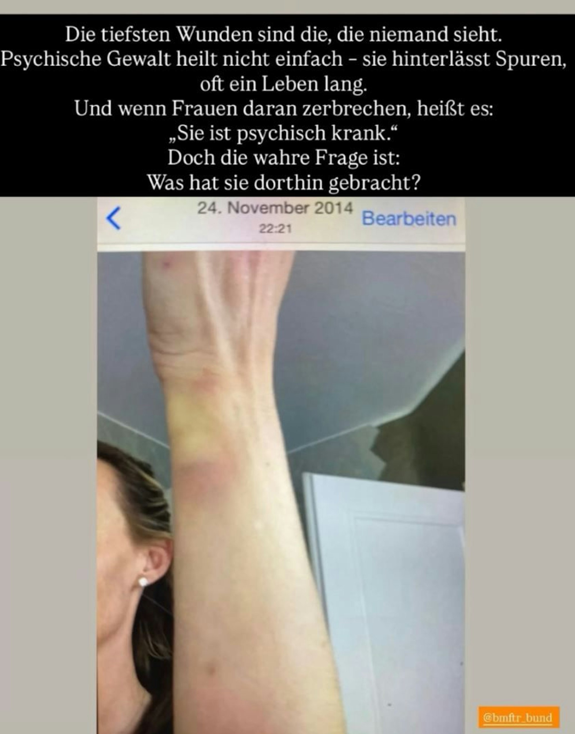 Cora Schumacher zeigt Blessuren.