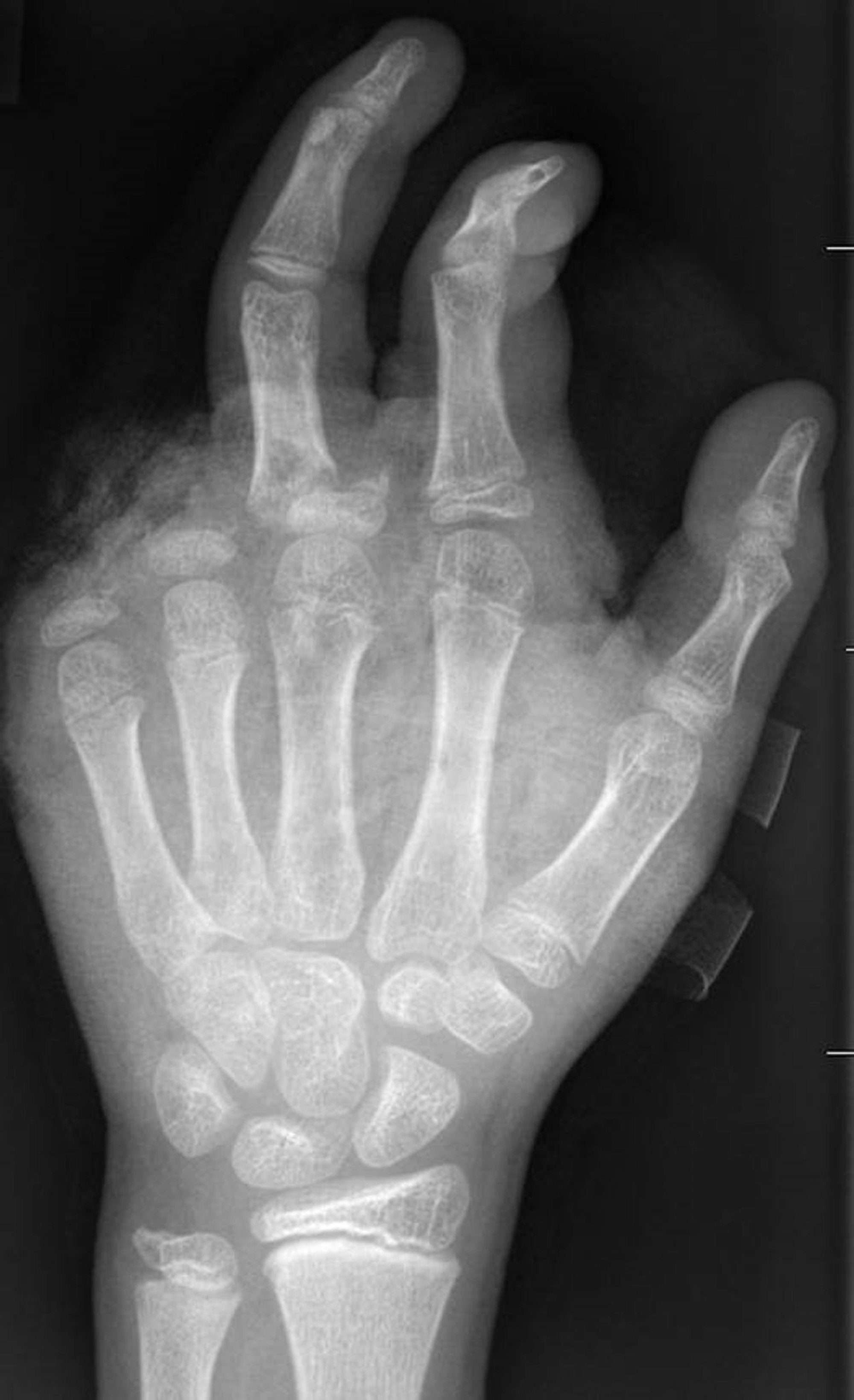 So kann ein Röntgenbild nach einer missglückten Böllerexplosion aussehen: Zwei Finger fehlen.