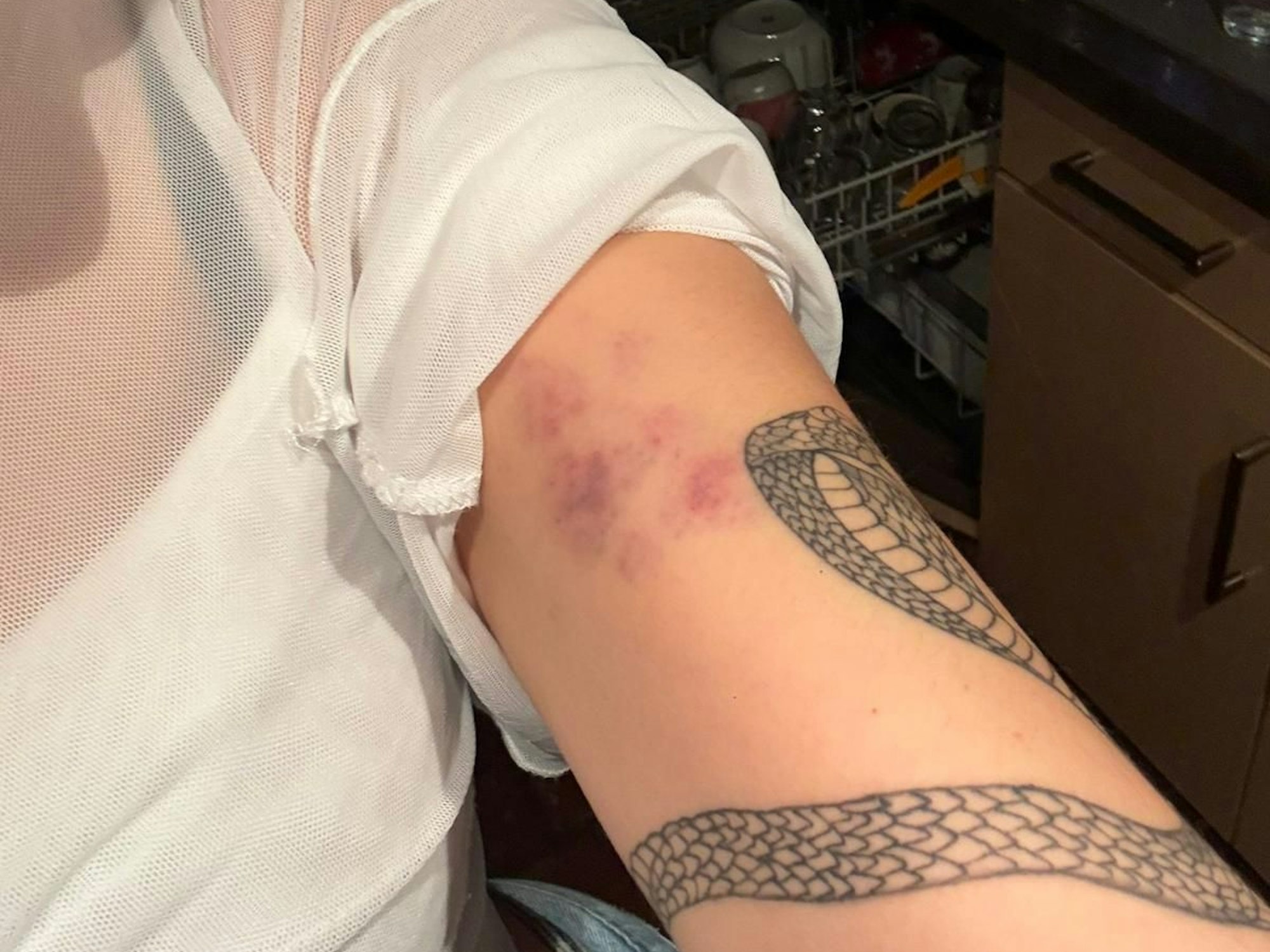 So sah der Arm von Rosa Jacob nach dem Spiel des FC gegen Mainz 05 aus.