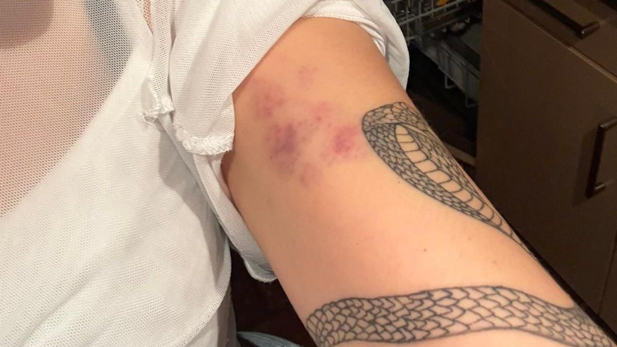 So sah der Arm von Rosa Jacob nach dem Spiel des FC gegen Mainz 05 aus.