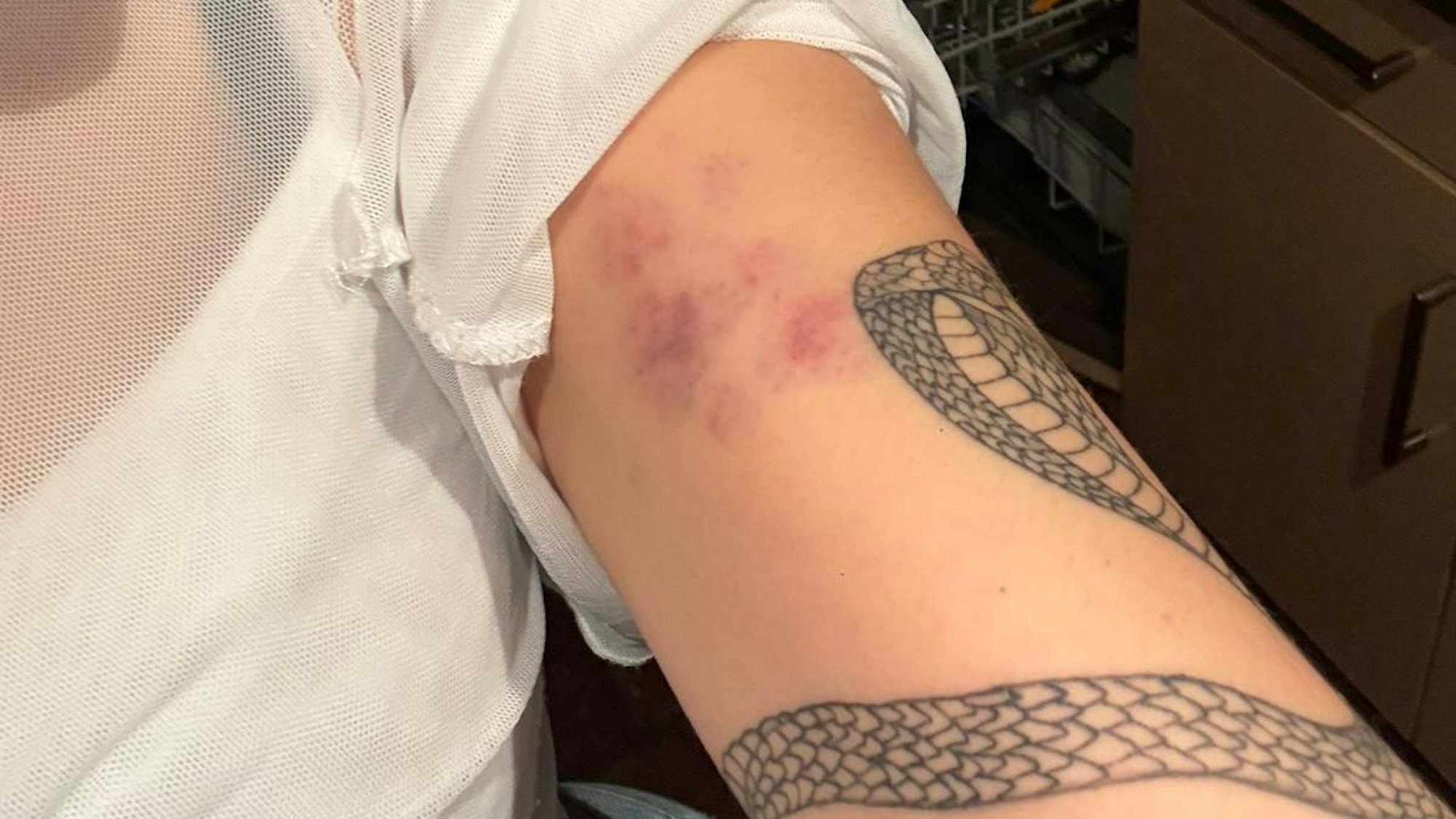 So sah der Arm von Rosa Jacob nach dem Spiel des FC gegen Mainz 05 aus.