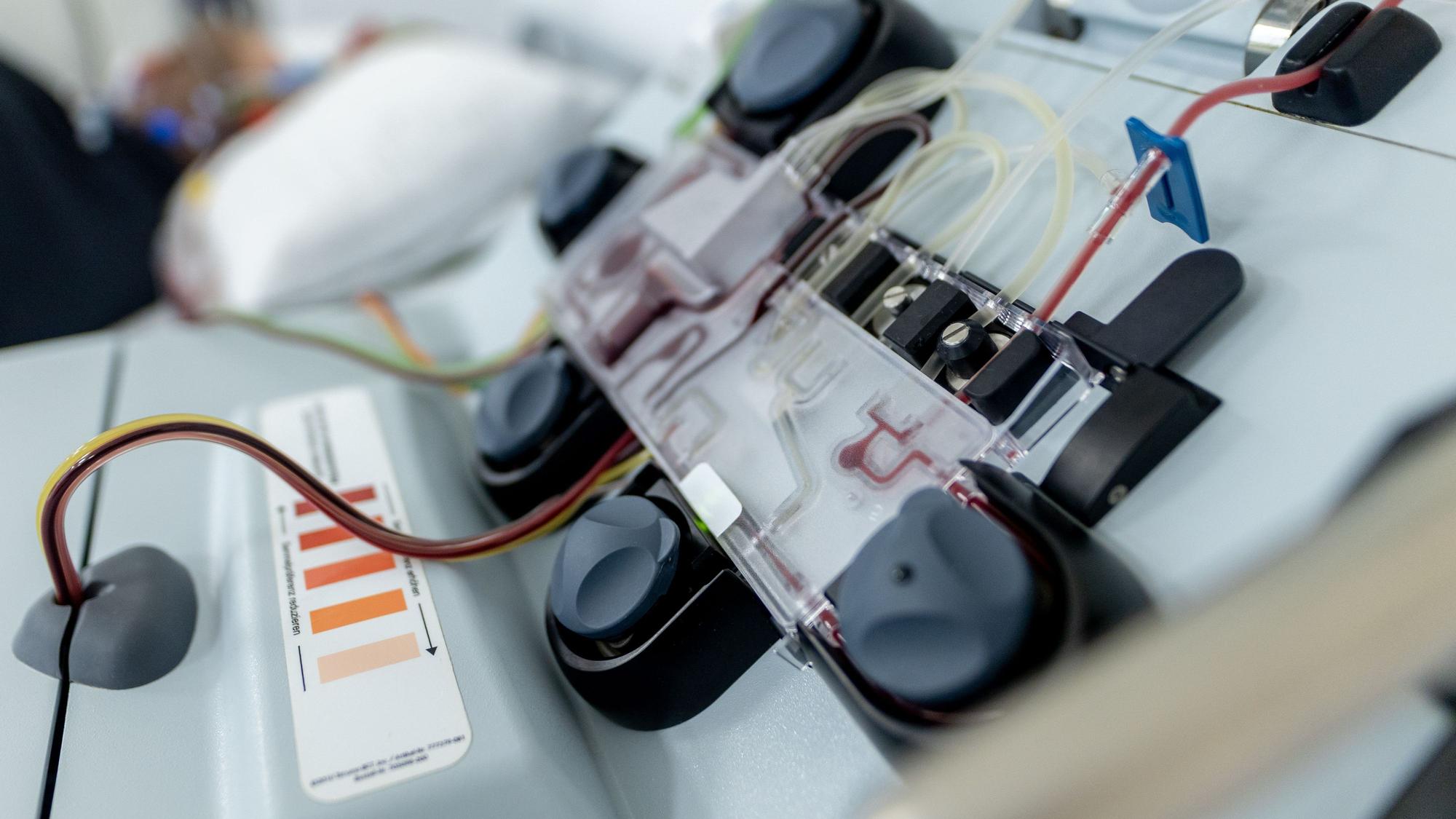 Über Schläuche und Drehteller wird das Blut aus der Vene der Patientin gewaschen. Im Beutel landet die sogenannte weiße Schicht mit den T-Zellen, der Rest der Flüssigkeit fließt zurück in den Körper der Patientin.