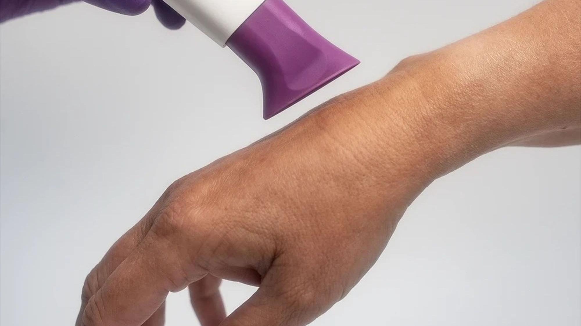 Zu sehen ist das Kaltplasmagerät im Einsatz an einer Hand.