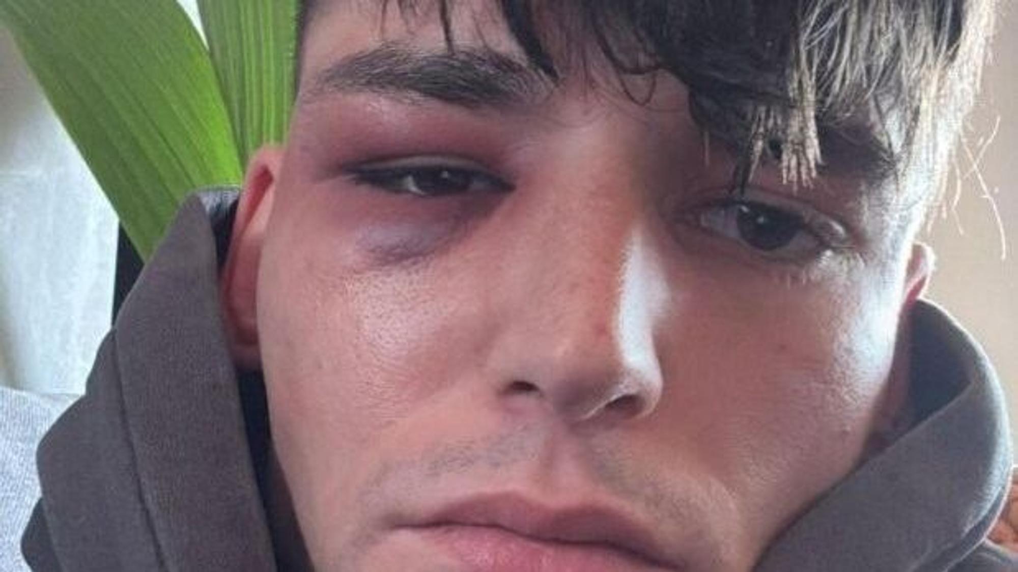 Pascal Kaiser veröffentliche ein Foto mit blauem Auge, nachdem er angegriffen worden sein soll.