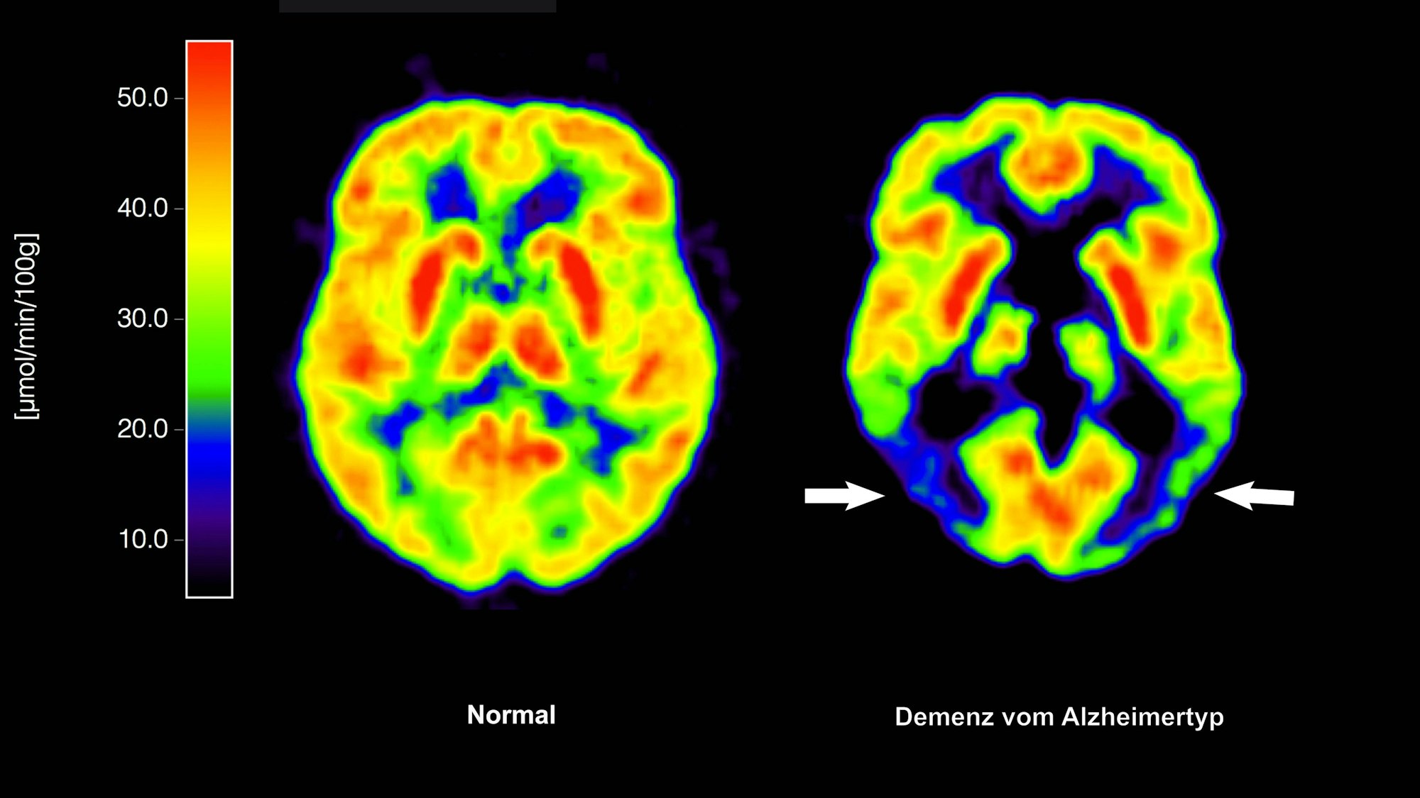 Die mit der Positronen-Emissions- Tomografie (PET) erstellte Abbildung zeigt die Gegenüberstellung zweier Gehirne - im gesunden Zustand (l) und mit Alzheimer-Krankheit.