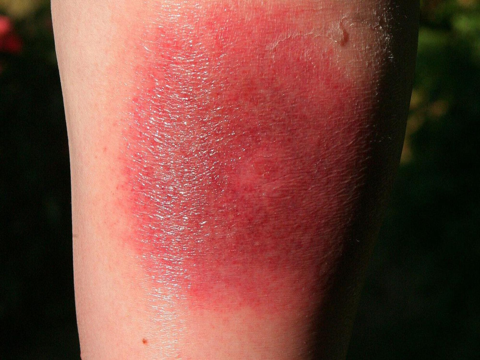 Klares Warnzeichen für Borreliose: Die sogenannte Wanderröte kann Tage oder Wochen nach einem Zeckenstich auftreten.