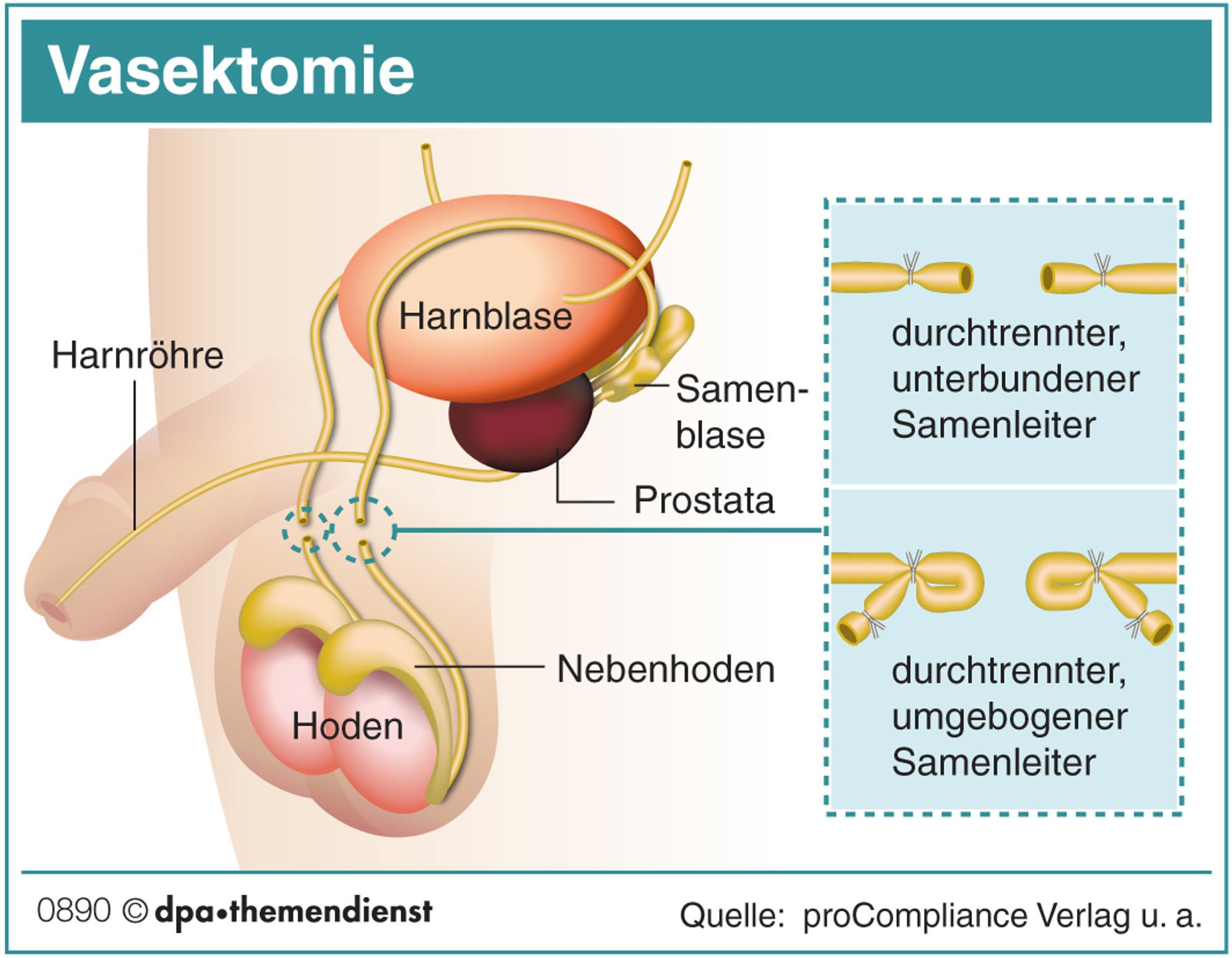 Vasektomie_Grafik_dpa
