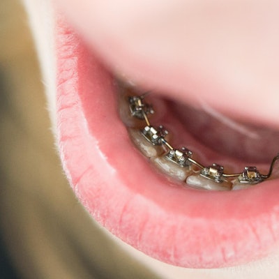 Kind trägt eine feste Zahnspange