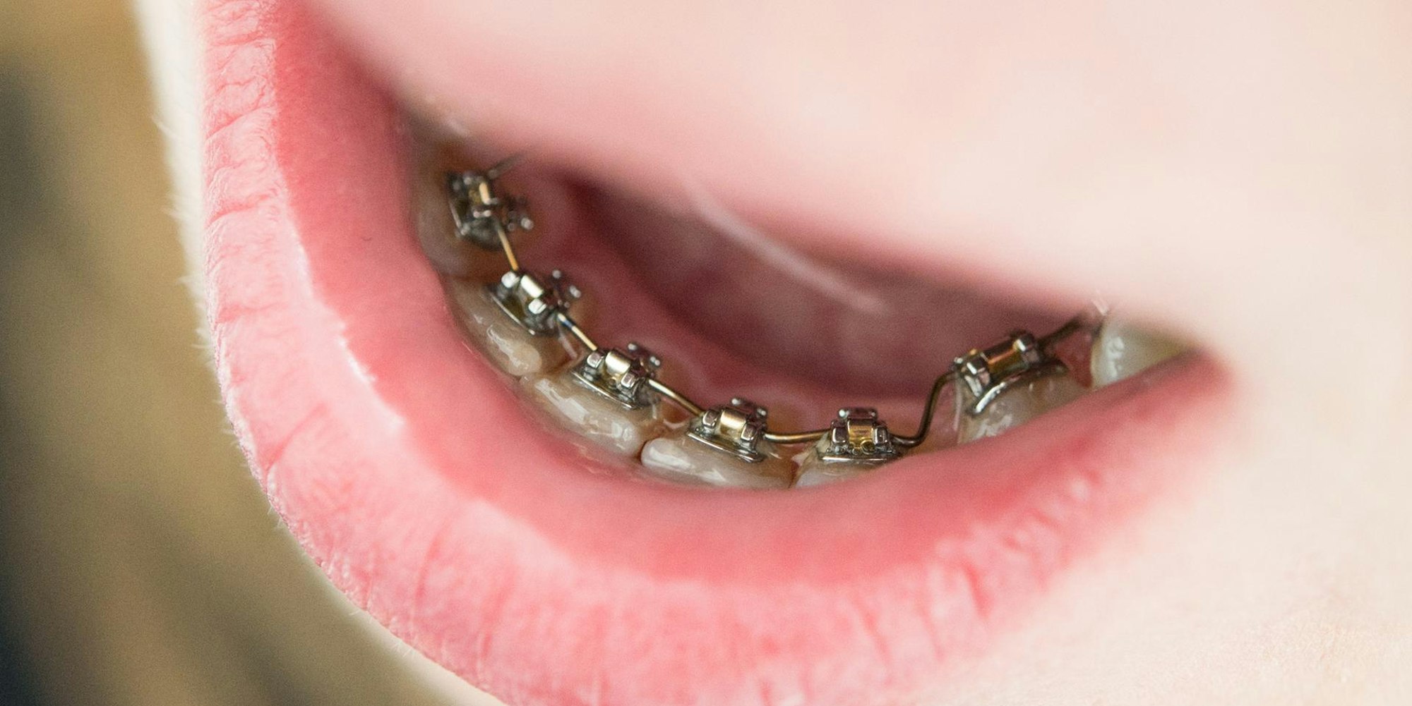 Kind trägt eine feste Zahnspange