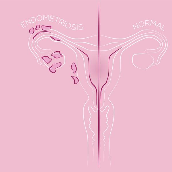 Eine Illustration von Endometriose im Vergleich zu einer gesunden Gebärmutter.