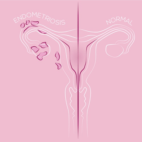 Eine Illustration von Endometriose im Vergleich zu einer gesunden Gebärmutter.