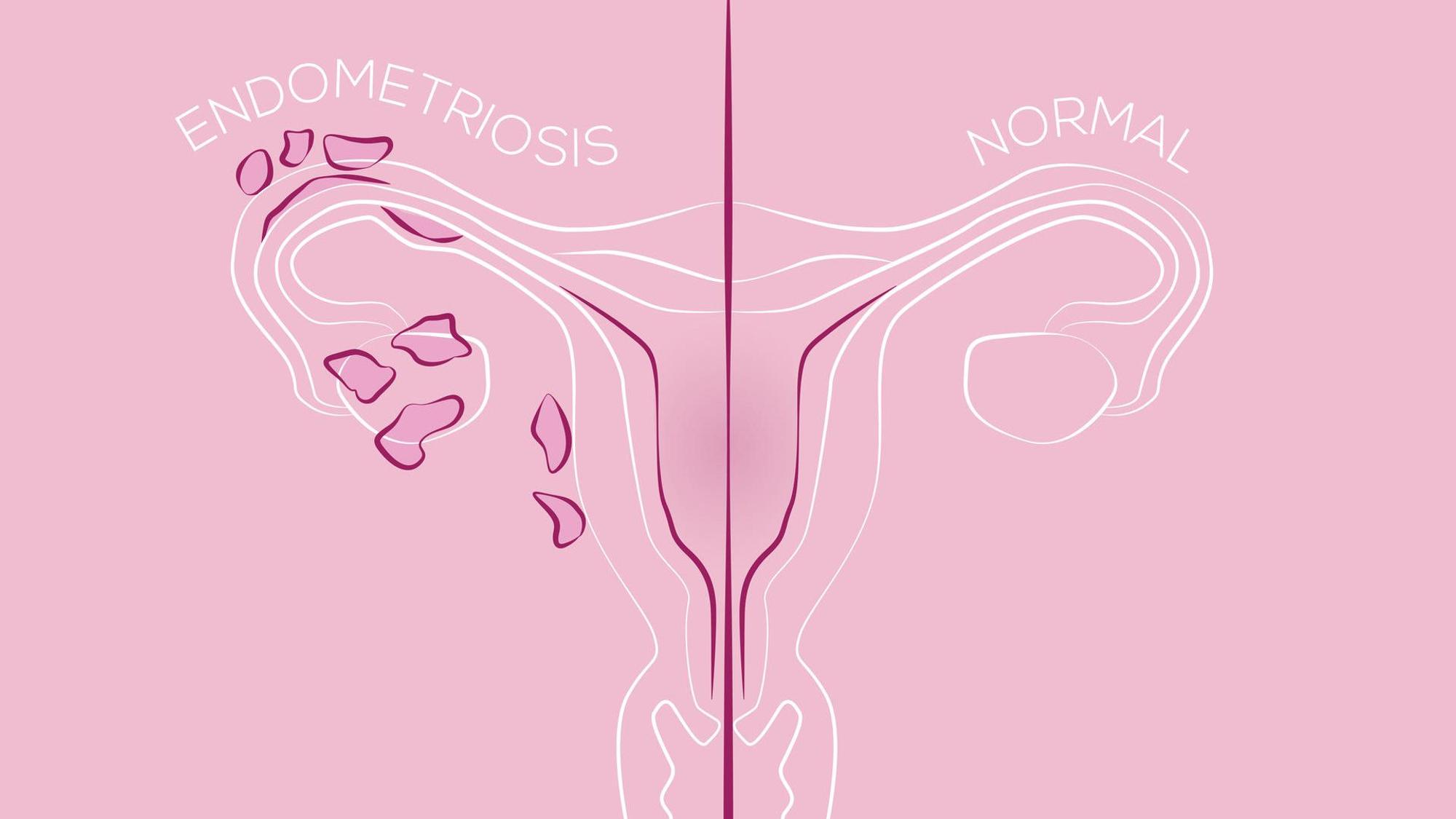 Eine Illustration von Endometriose im Vergleich zu einer gesunden Gebärmutter.