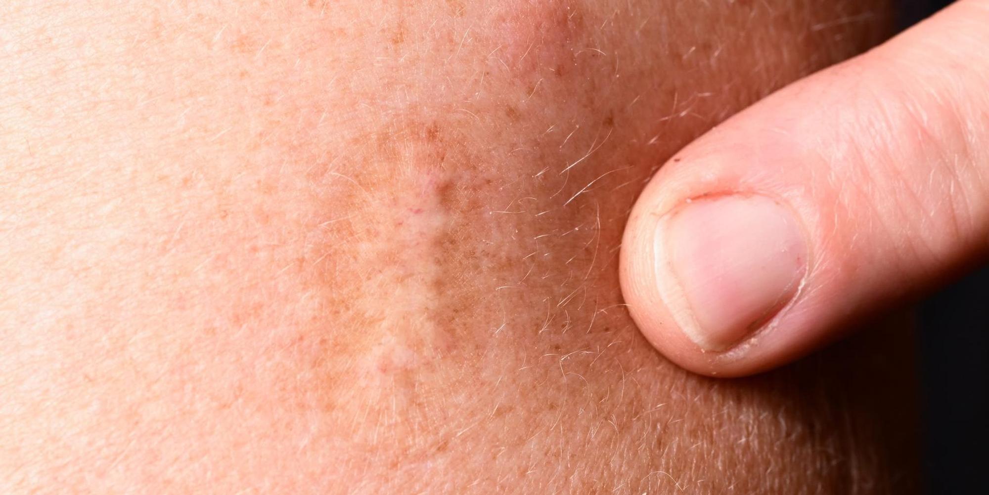 Pockenimpfung