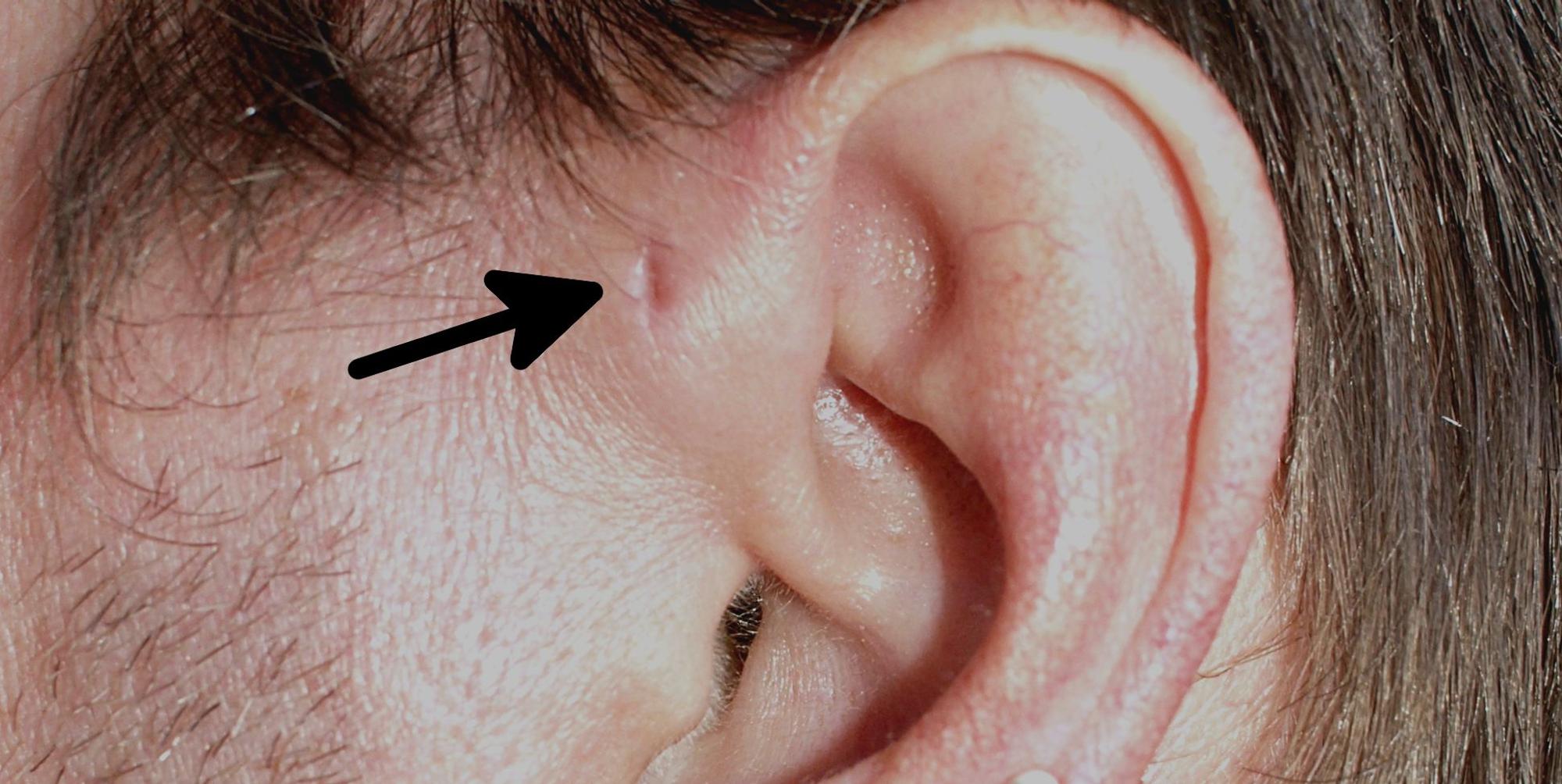 Fistula_auris