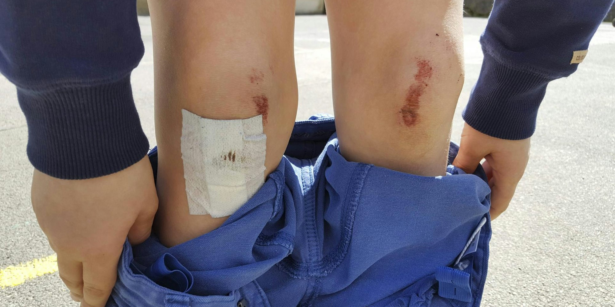 Mensch zeigt seine aufgeschürften_Knie