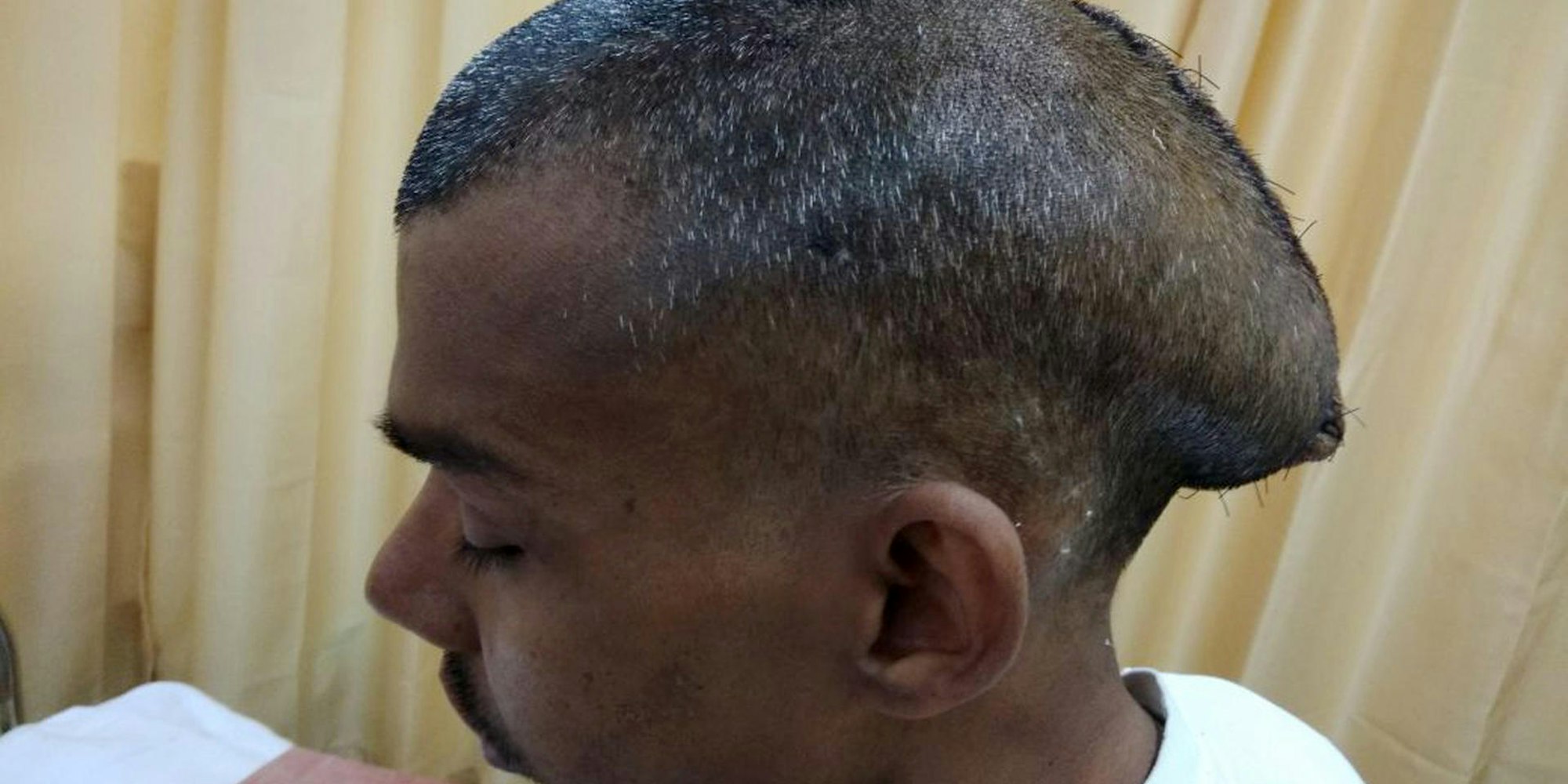 Indien Tumor 2