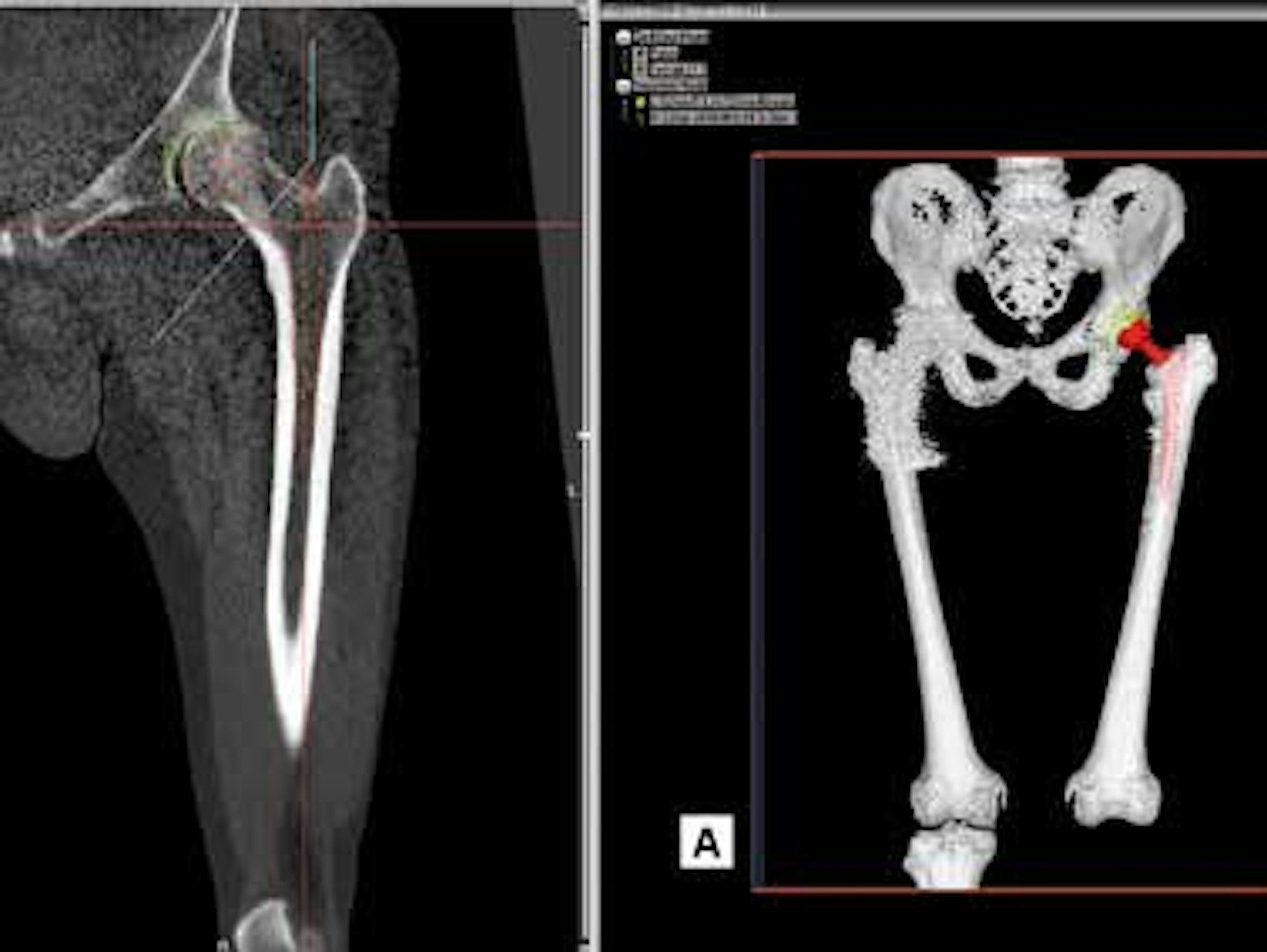 Verfahren zur Planung von Endoprothesen