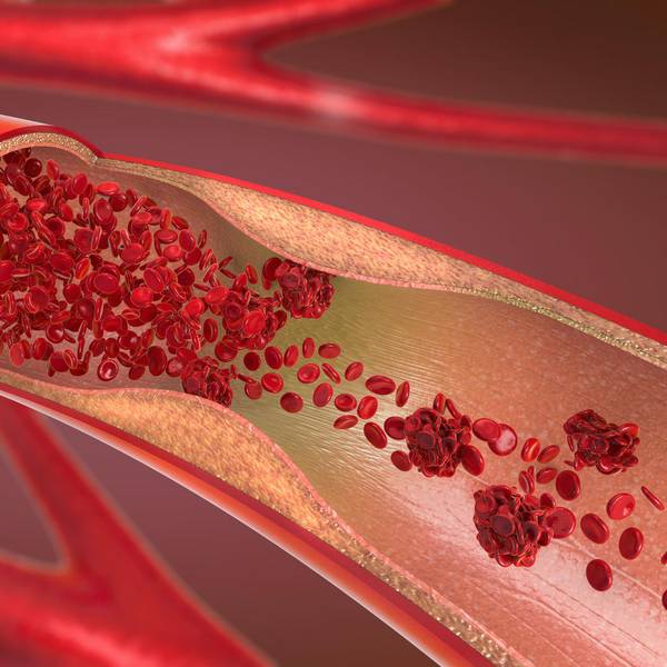 Verstopfte Arterie Getty Images