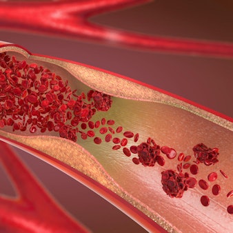 Verstopfte Arterie Getty Images