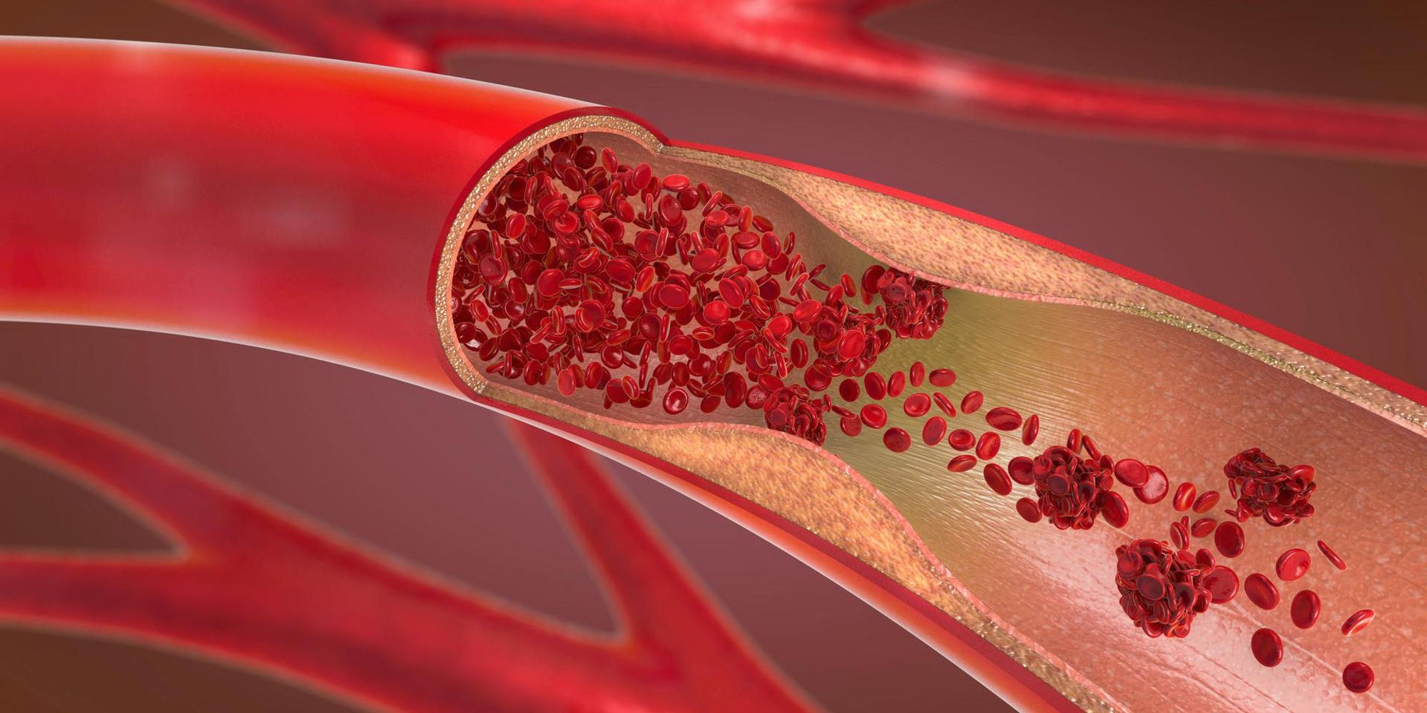 Verstopfte Arterie Getty Images